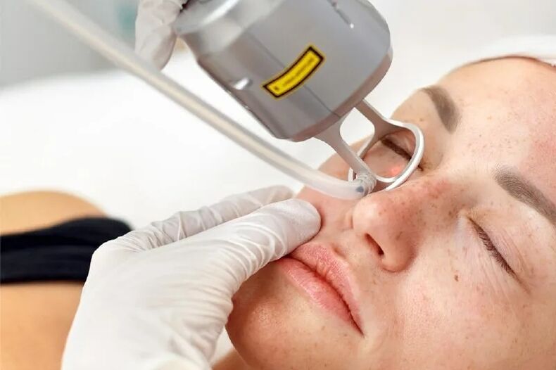 plataforma de laser para correção de pele facial